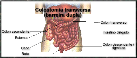 colostomia transversa