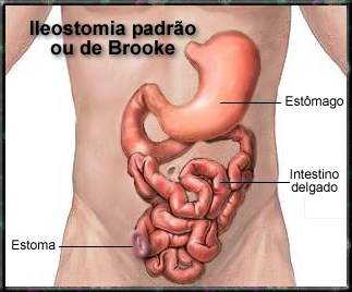 Ileostomia padrão ou de Brooke
