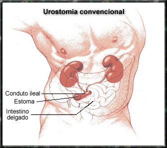 urostomia convencional