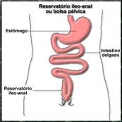 Reservatório íleo-anal