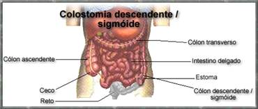 colostomia sigmoide