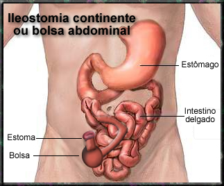 Ileostomia continente